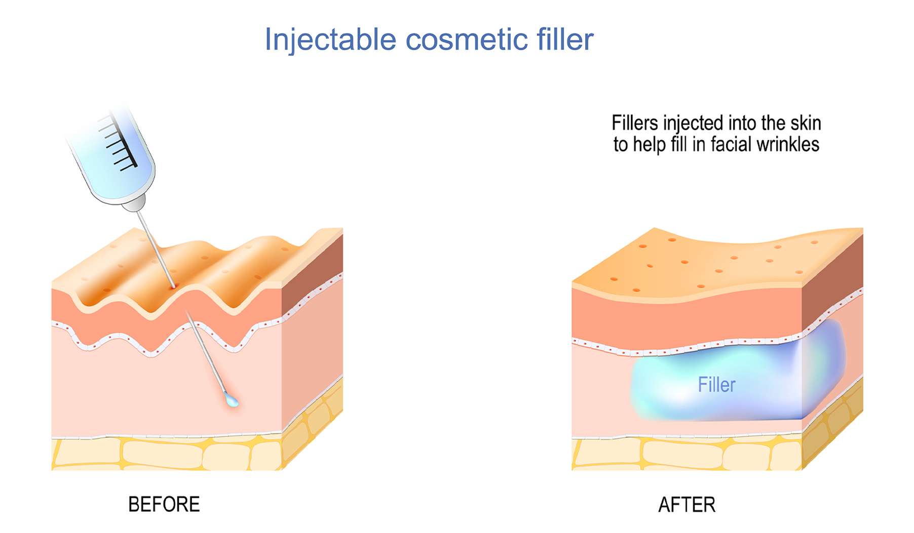 injectable